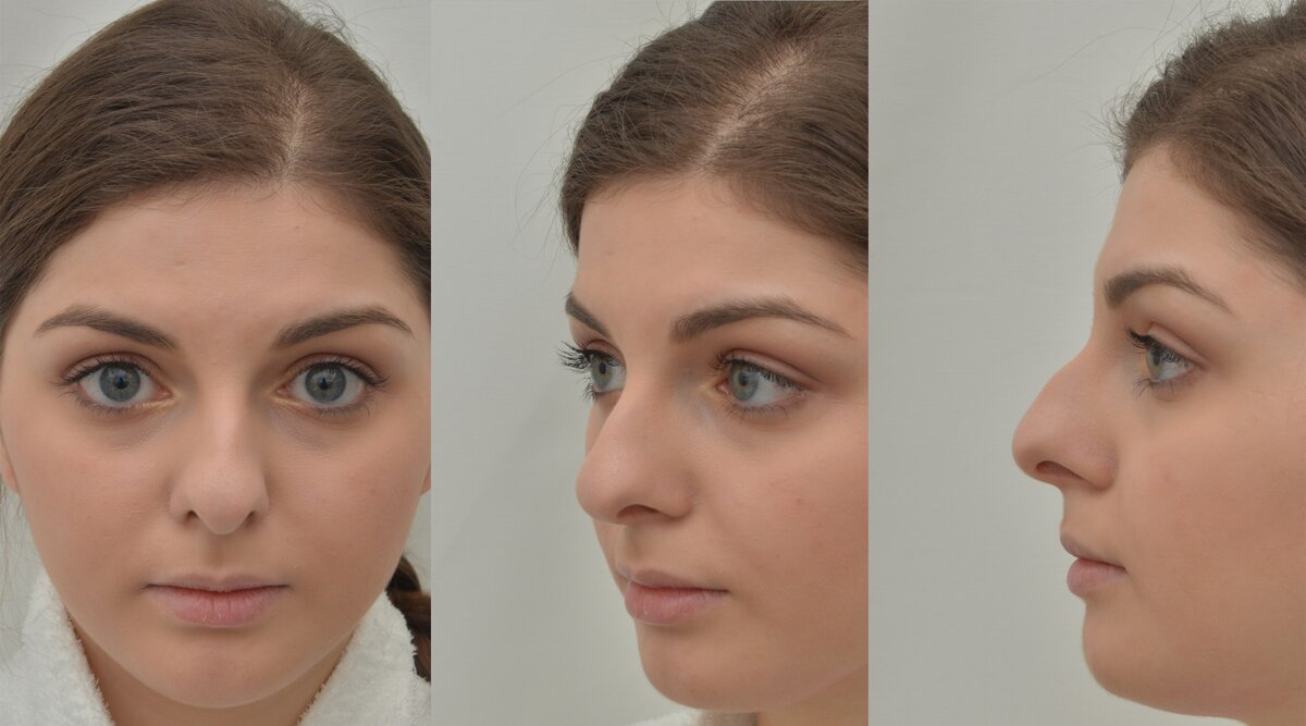 Перед пластической операцией - ринопластикой