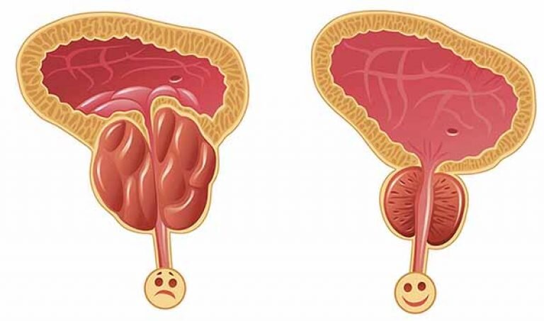 Отсутствие своевременного лечения острой формы простато везикулита чревато ее трансформацией в хроническую форму. А она уже грозит воспалением простаты и другими сопутствующими проблемами. 