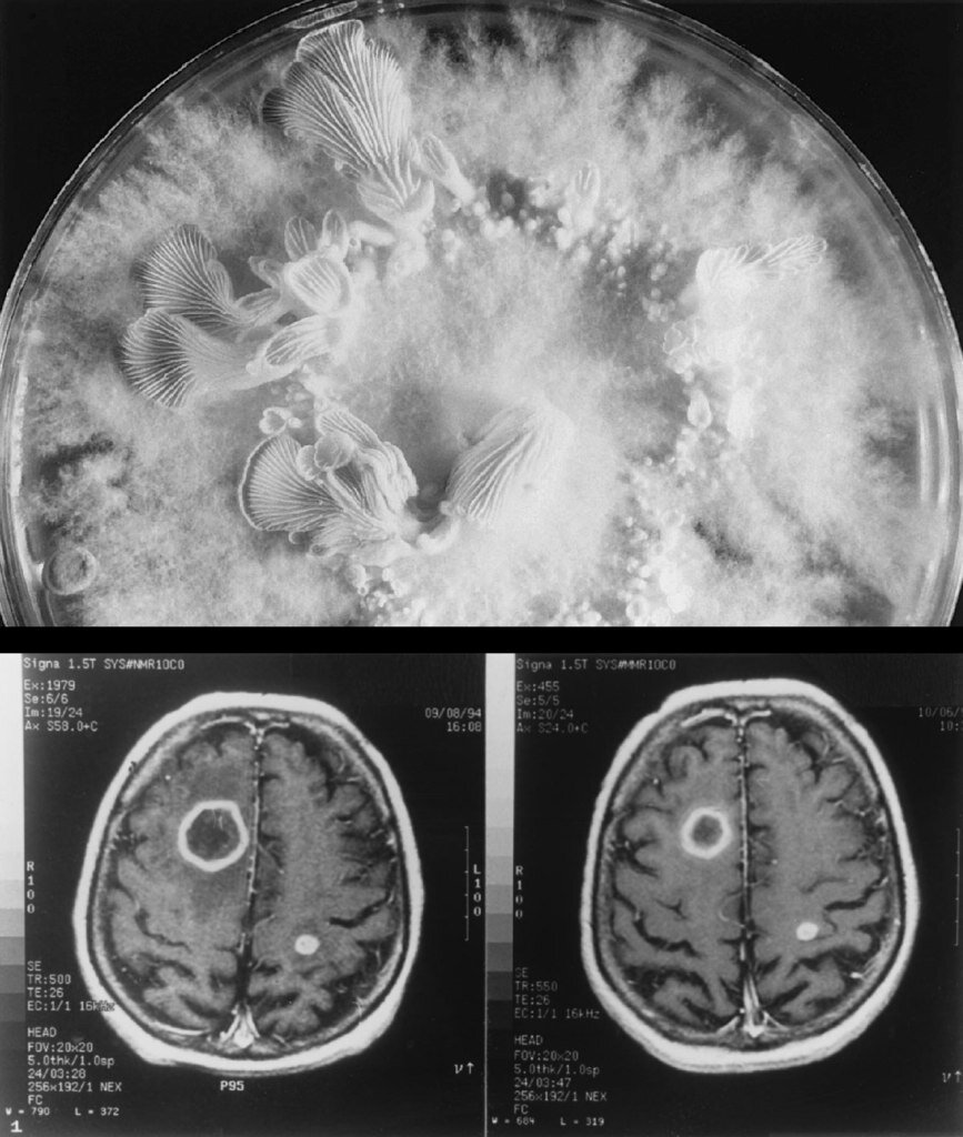 Сверху – колония Schizophyllum commune на среде Чапека, сформировавшая плодовые тела через две недели после посева. 
Внизу – изображение пораженного мозга (возможно Ленина), полученное методом магнитно-резонансной томографии. 

Изображения из статьи (Rihs et al, 1996)