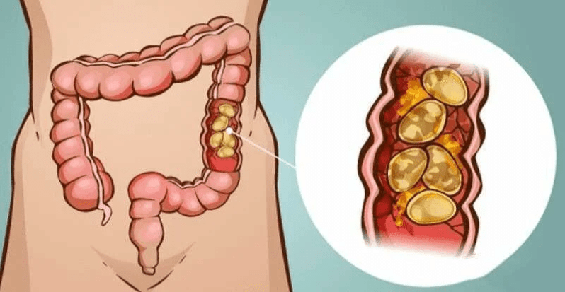 Это нарушение работы всего организма вследствие проникновения в кровоток продуктов брожения и гниения.  Иногда признаком такого состояния является только постоянная и длительная сонливость и усталость, которая не проходит после длительного сна и полноценного отдыха.
Каловая интоксикация – хроническое состояние, при котором каловые массы накапливаются в дистальных отделах кишечника. В результате этого активизируются процессы гниения и брожения, в кровь попадают токсичные продукты, нарушается функционирование нервной системы, кожи и других органов. Смертельной опасности эта ситуация для человека не представляет, но существенно ухудшается качество жизни.

При отсутствии стула более 1-2 суток в кишечнике накапливается большое количество остатков белковой пищи, которые перегнивают с образованием токсинов. Стенки кишок обладают хорошей всасывающей способностью, поэтому продукты распада попадают в кровь и негативно воздействуют на внутренние органы, в первую очередь — на центральную нервную систему.

При длительных запорах часть токсинов выводится из кровяного русла через кожу, печень и почки, что может спровоцировать дерматологические проблемы (воспаления, прыщи, шелушение), изменение цвета естественных выделений и снижение печеночной и почечной функций.
В зависимости от длительности и интенсивности проявления симптомов гастроэнтерологи и проктологи выделяют острую, подострую и хроническую интоксикацию.
На фоне длительного отравления токсинами происходят изменения водно-электролитного баланса организма, что негативно сказывается на функции сердца, ЦНС, почек, легких и печени. Насыщение крови токсинами приводит к снижению работоспособности, хронической усталости и ухудшению памяти у взрослых. 