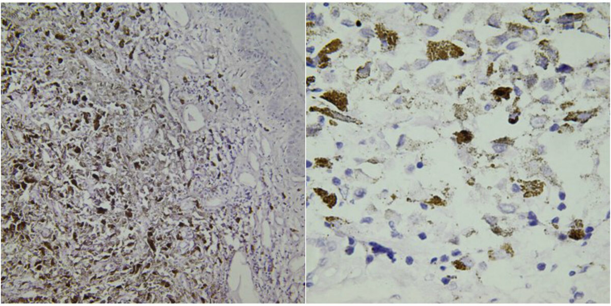 Морфологическая картина характерная для меланомы