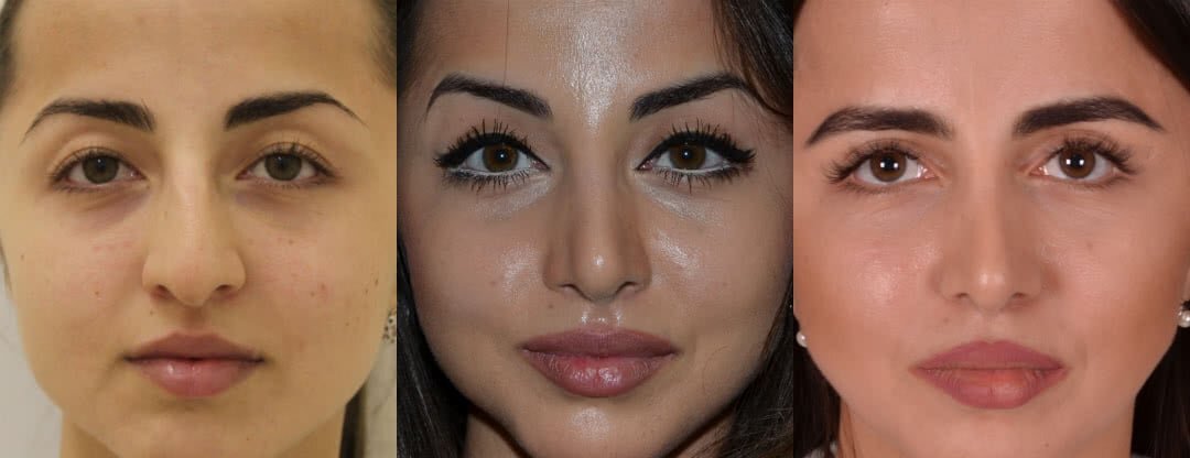 Ринопластика носа фото до и после. Фото с сайта Д.Р. Гришкяна. Имеются противопоказания, требуется консультация специалиста