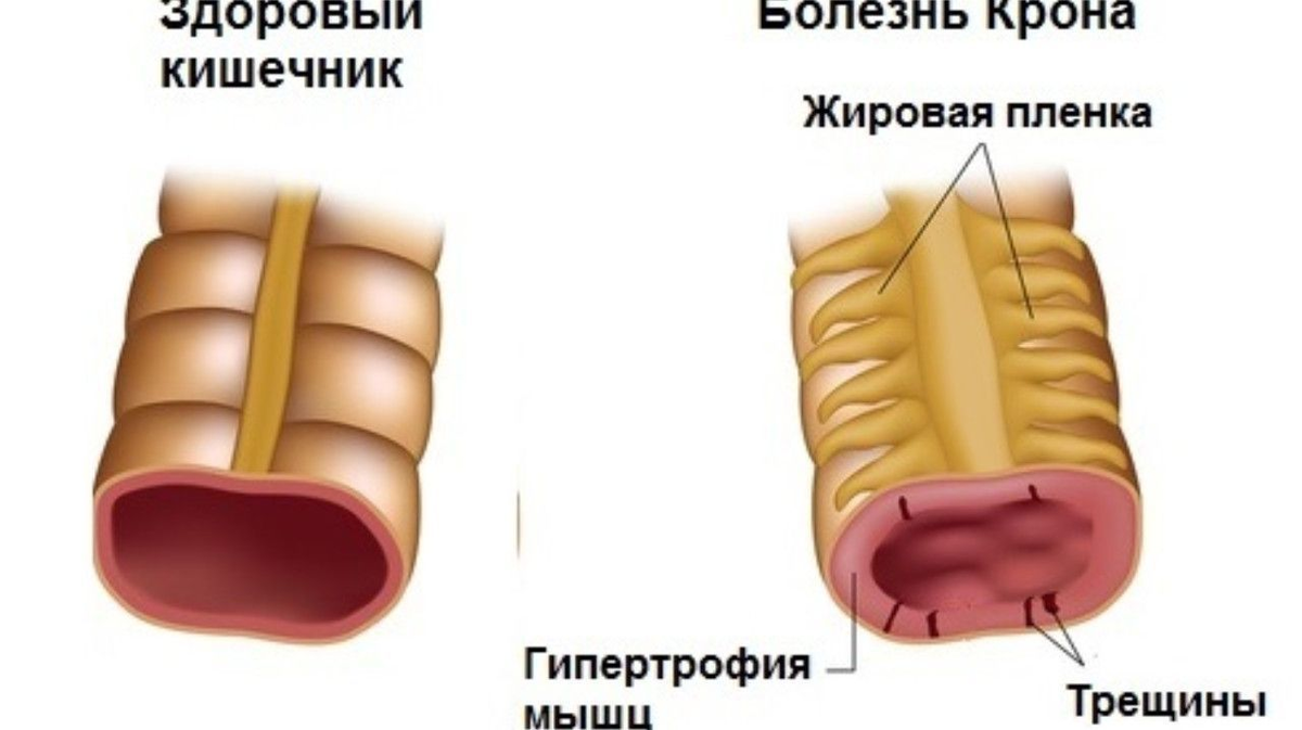 Болезнь Крона — главное о заболевании | Evolutis Clinic | Дзен