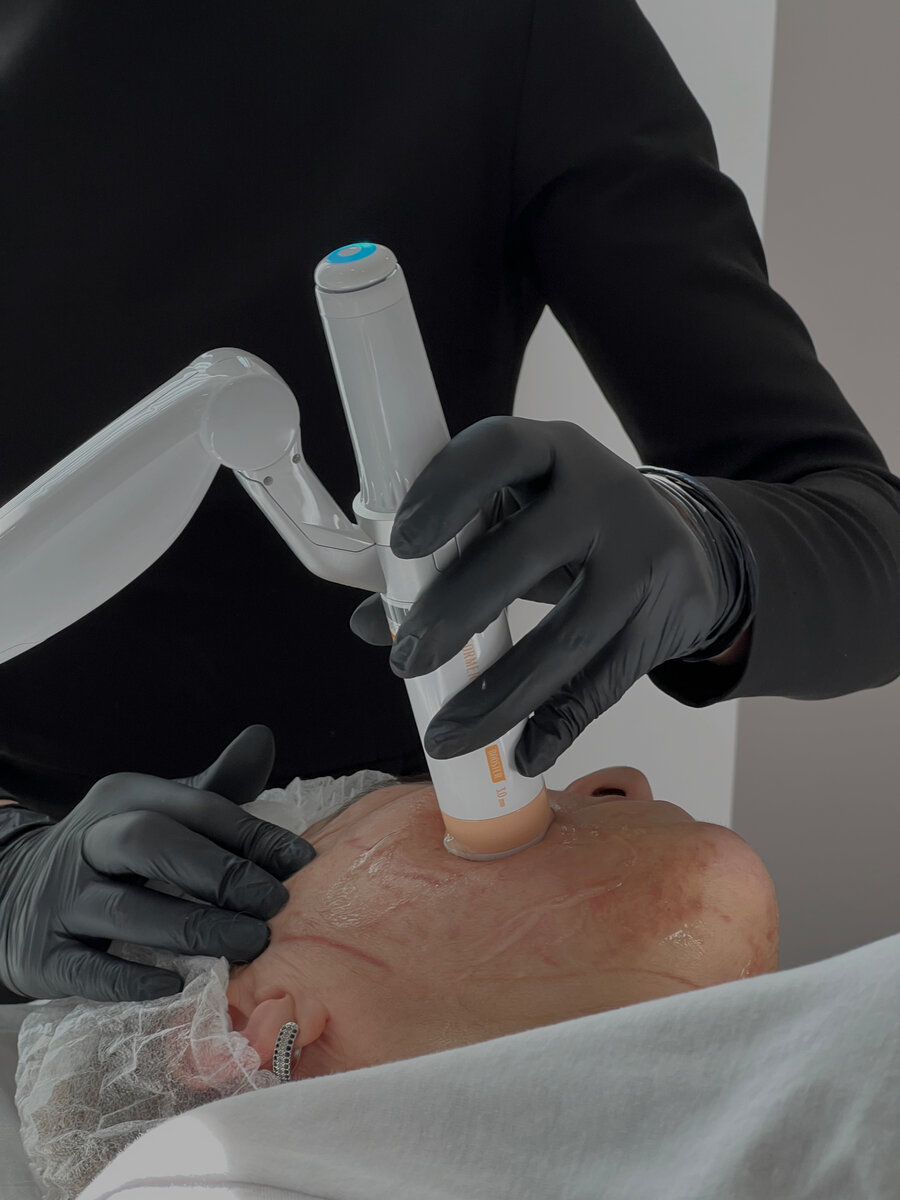 Выполнение процедуры: SMAS-лифтинг лица на медицинском аппарате Ultraformer MPT / Mpt toning — в центре медицинской косметологии YAPOKRASOTE.