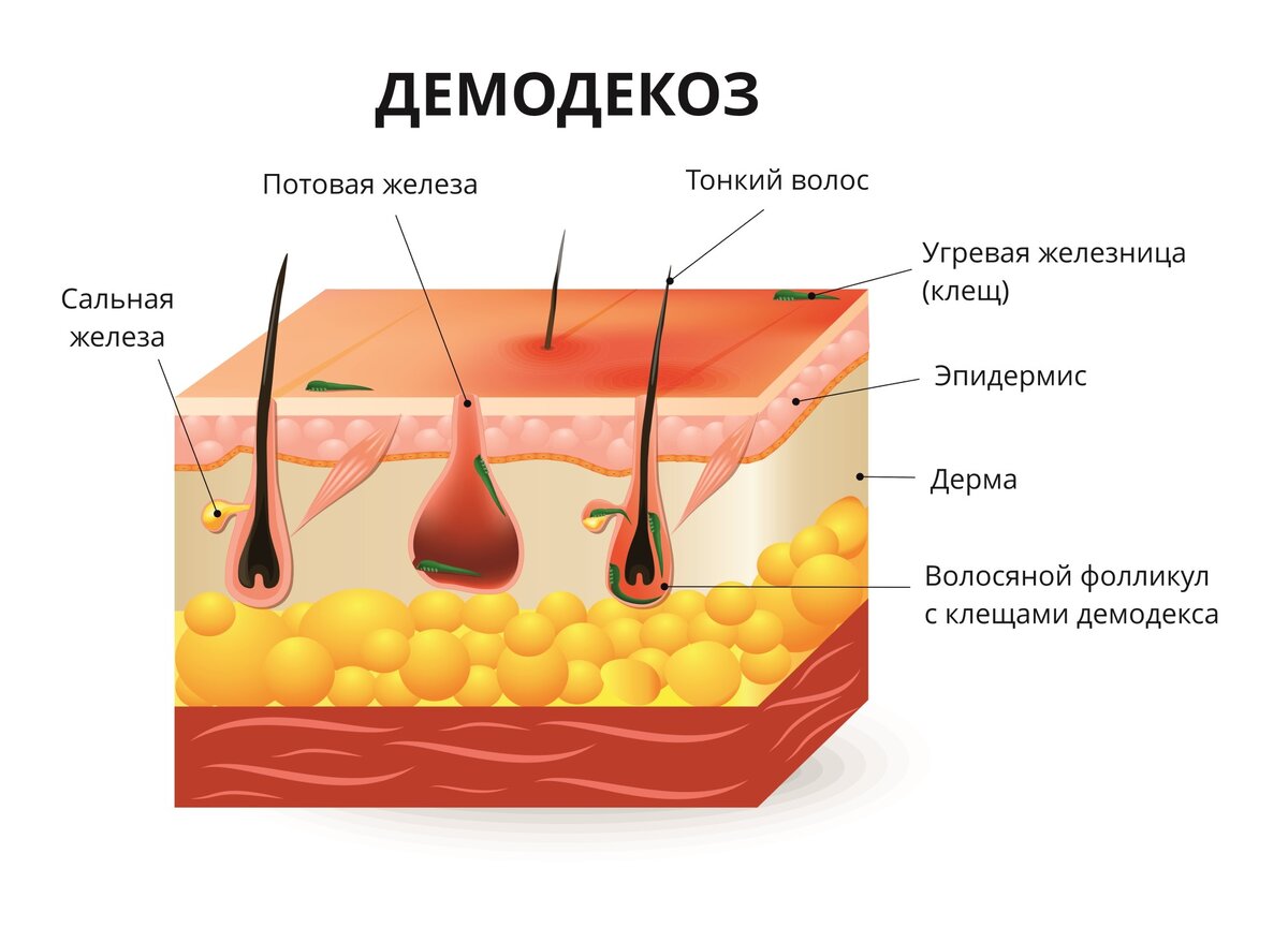 Как выглядит демодекоз с точки зрения клеток кожи.