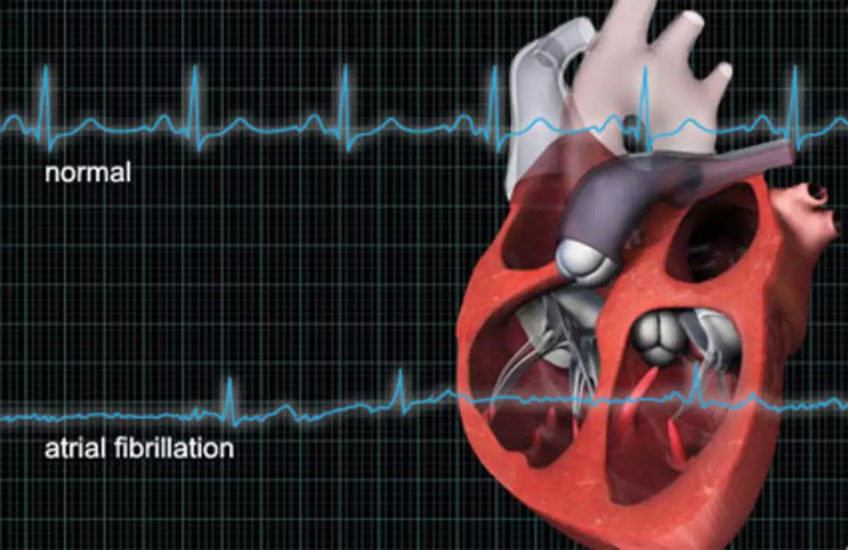 Мерцательная аритмия: без лечения возможны тромбы и проблемы с головным  мозгом | О здоровье: с медицинского на русский | Дзен