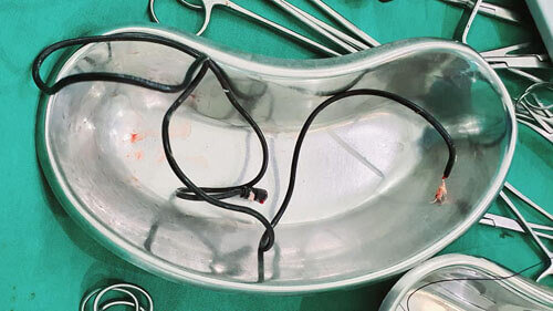 К хирургу в Индии обратился мужчина с болями в животе. Как признался сам дяхус,он проглотил шнур от зарядки ))) Вы думаете вот же дубина? Нееееет! 