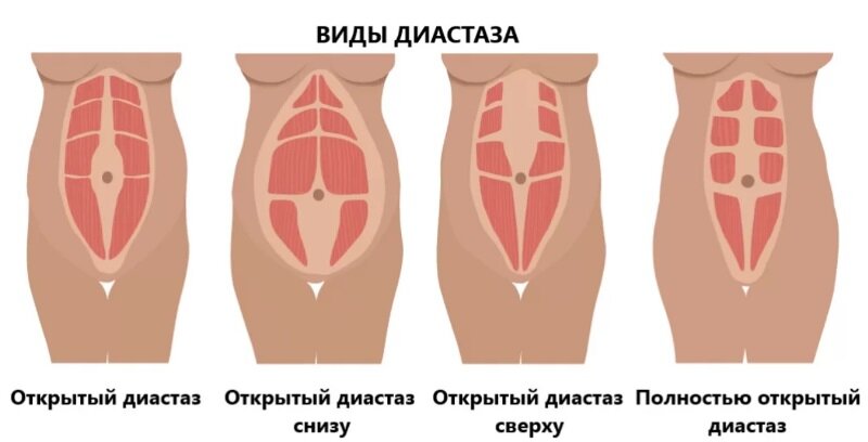 Диастаз это простыми словами у женщин фото Как распознать диастаз после родов? Plastichno Дзен