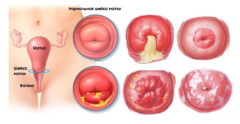 Эрозия шейки матки: обследование и лечение