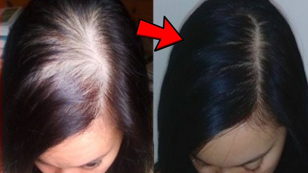 #лечениеволос #выпадениеволос #облысение #какотраститьволосы #уходзаволосами #уходзаволосами #дляроставолос 