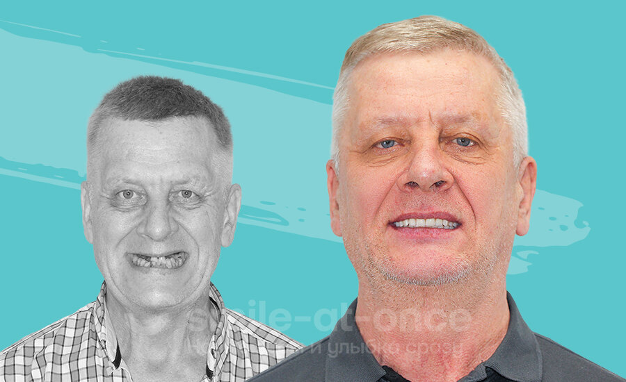 Фото пациентов клиники Smile-at-Once до и после установки комфортных протезов. Беззубая жизнь позади! Фото: Smile-at-Once.ru.