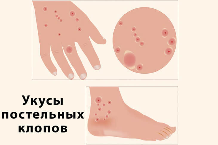 Укусы постельного клопа