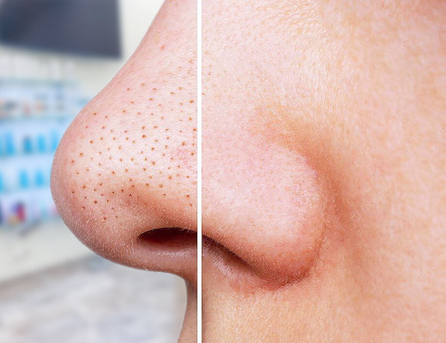 Расширенные поры часто встречаются у людей с дерматологическими заболеваниями (например, повышенном выделении себума, акне).