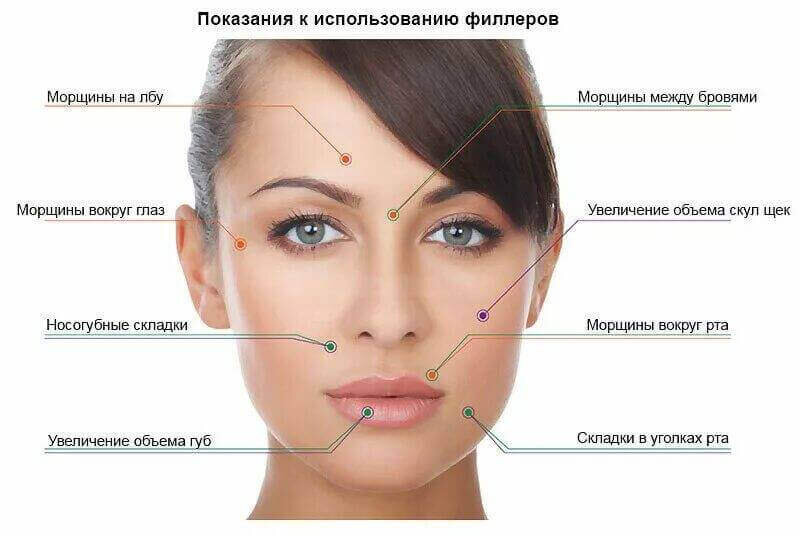 Филлеры в носогубные складки - обзор, цена, отзывы ⭐