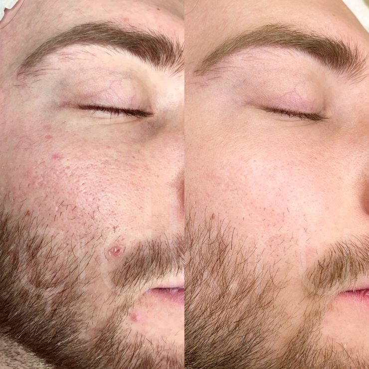 Игольчатый RF-лифтинг до/после