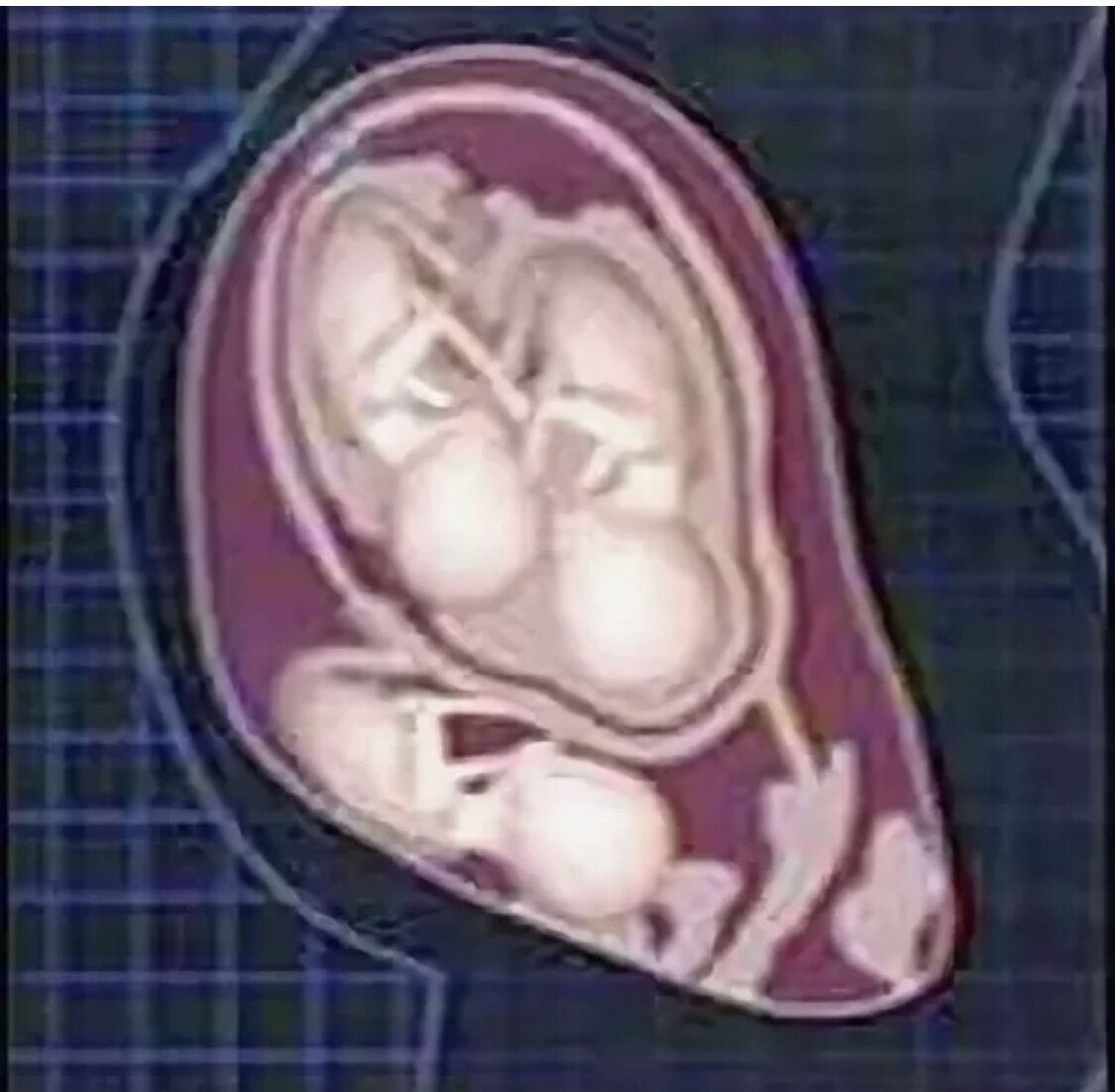 Близнецы 11 недель. Многоплодная беременность. Расположение двойни в животе.