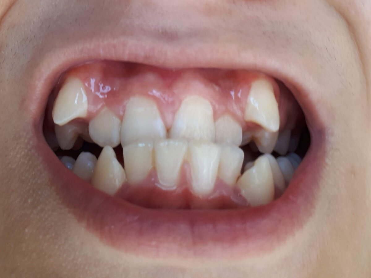 Мои зубы до брекетов