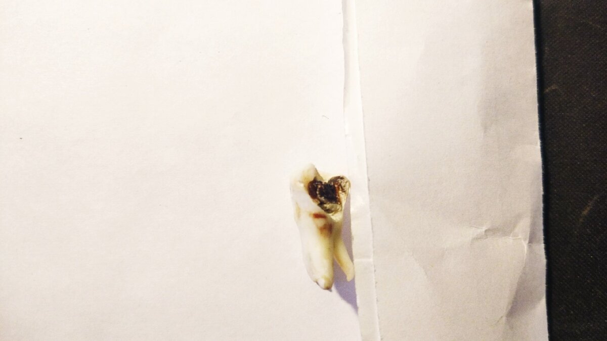 Черный внутри зуб