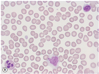 Мазок периферической крови здорового человека. Эритроциты представлены в виде множественных светло-розовых (оксифильных) клеток с просветлением в центре. Также видны здоровые нейтрофил, лимфоцит, моноцит и тромбоциты в виде мелких точек. Фото взято из Porwit A. et al. (eds.) - Blood and Bone Marrow Pathology (2nd ed.).