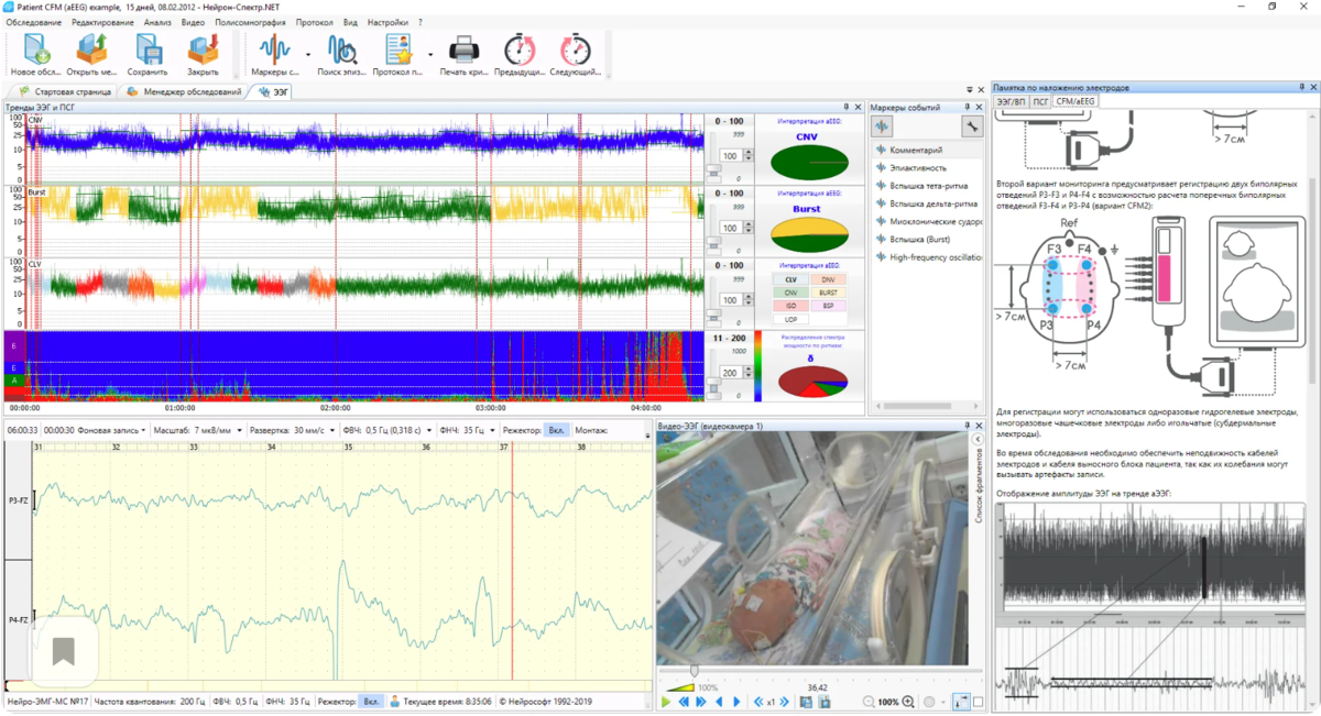 Амплитудно-интегрированная ЭЭГ