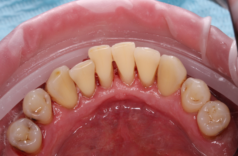 Зубной камень - налет курильщика. Фото сделано в процессе профессиональной гигиены полости рта