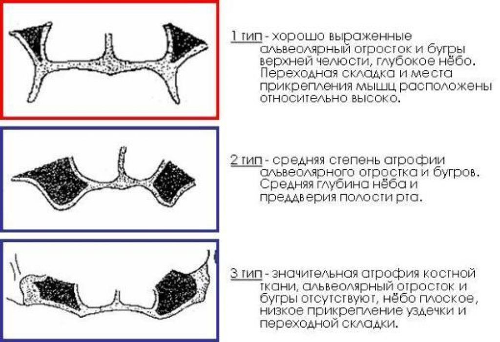 Беззубая челюсть по шредеру. Классификации Шредера для беззубой верхней челюсти. Классификация беззубых челюстей (Шредера, Келлера, Оксмана. Типы атрофии альвеолярного отростка по Шредеру. Классификация атрофии беззубых челюстей Шредера.