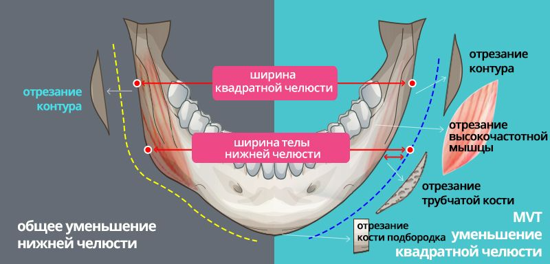 Челюсти длительность. Уменьшение нижней челюсти операция. Уменьшение ширины челюсти. Уменьшение квадратной челюсти.