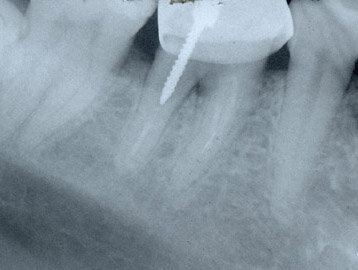 Что такое анкерные штифты и как они удаляются из зубов