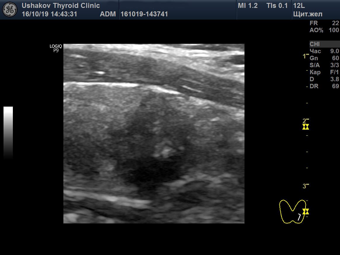 Левая доля щитовидной железы, продольная проекция. Среди темной (гипоэхогенной) ткани узла видны светлые элементы - микрокальцинаты.