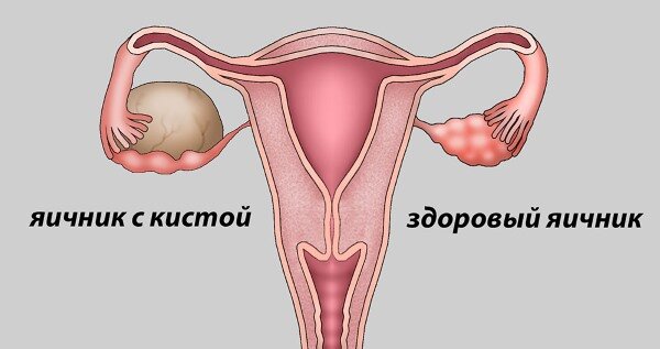 Не пропустить рак. 10 вопросов о кистах и опухолях яичников