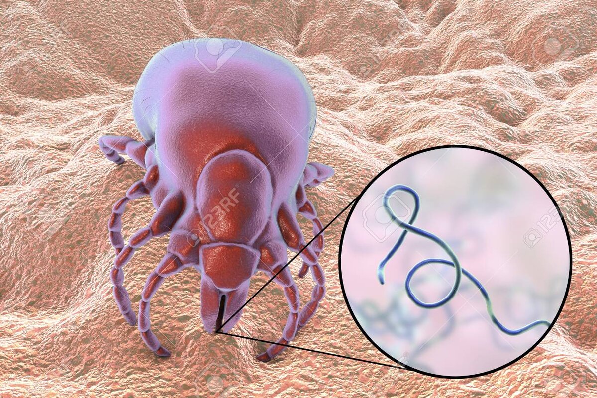 Borrelia burgdorferi