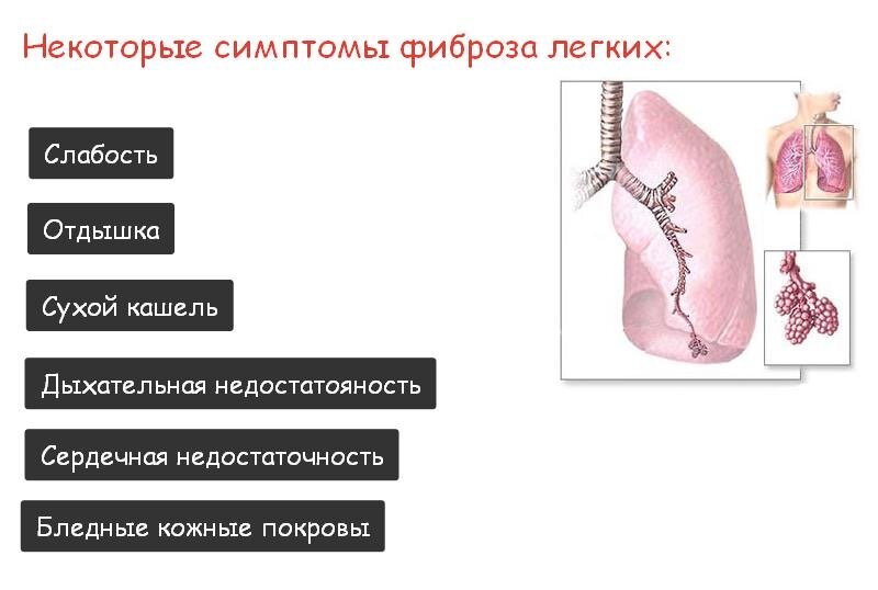 Что такое фиброз. Заболевания, для которых характерно развитие легочного фиброза:.