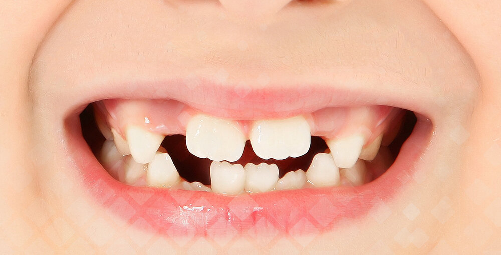 Зачем рекруты в прошлом выбивали себе передние зубы? | дневник ролевика | Дзен