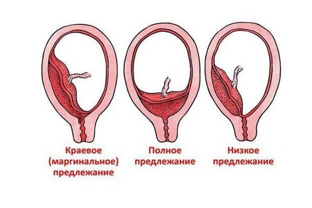 Что такое пробка у беременных, как она выглядит и как отходит?