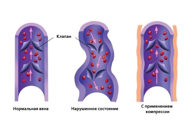 Правильная компрессия: зачем нужна спортивная компрессионная одежда
