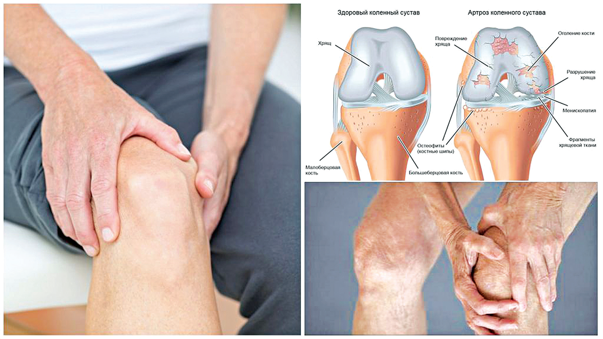 Колено стучит. Клинические проявления гонартроз. Гонартроз контрактура. Артрозо-артрит коленного сустава. Гонартроз коленного сустава 2.