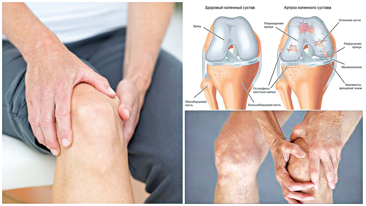 Артроз колена как называется. Клинические проявления гонартроз. Гонартроз контрактура. Артрозо-артрит коленного сустава. Гонартроз коленного сустава 2.