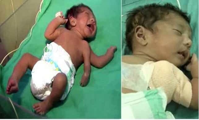 Полимелия - редкий (один случай на миллион родившихся) генетический дефект, при котором ребенок рождается на свет с лишними конечностями. Самый недавний и известный случай полимелии произошел в 2014 году в Индии, где родился мальчик с двумя левыми руками. Ребенку повезло: врачи, несмотря на риск, связанный с операциями у младенцев, быстро удалили лишнюю конечность. Мальчик благополучно оправился после операции.  
