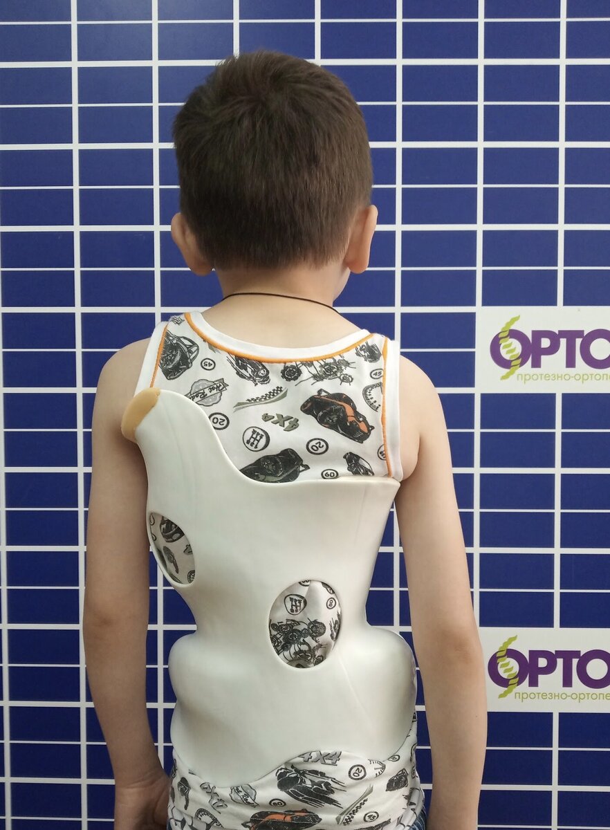 Сколиоз у детей.