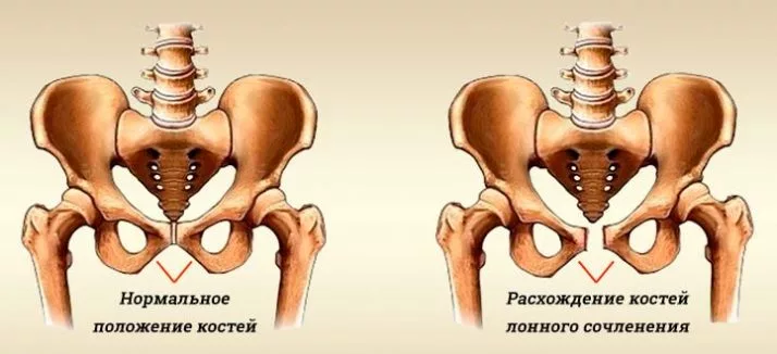 Симфизит при беременности фото