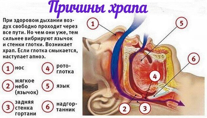 [caption id="attachment_5904" align="aligncenter" width="700"] Причины храпа[/caption]
