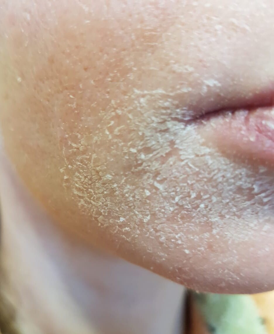 Почему шелушится кожа на лице и что делать | Блог | Complimed