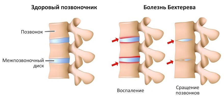 Позвоночник при болезни Бехтерева