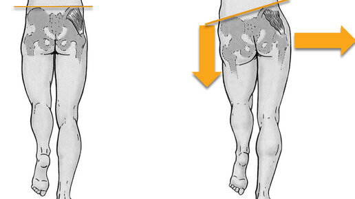 Походка Трендельбурга. Разбор и диагностика. Упражнения