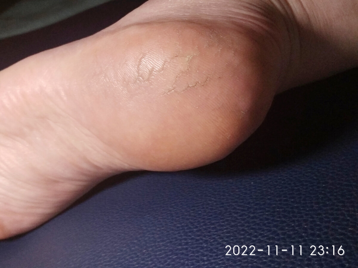 3-й день. Обработка пяток единоразовая дополнена каждодневным нанесением натурального масла.