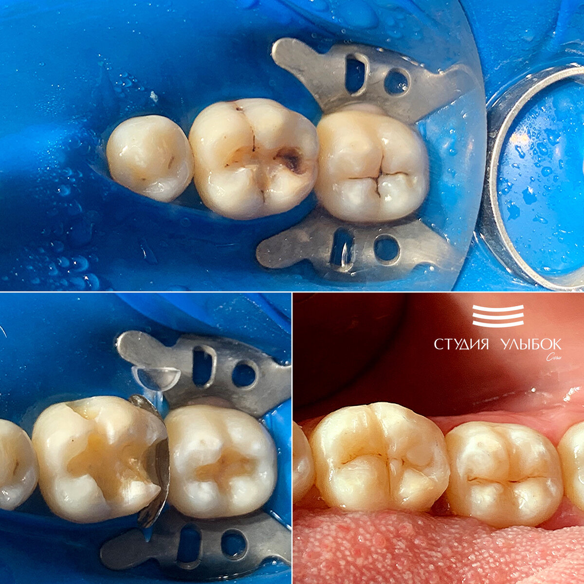 Лечение среднего кариеса 36,37 зубов 