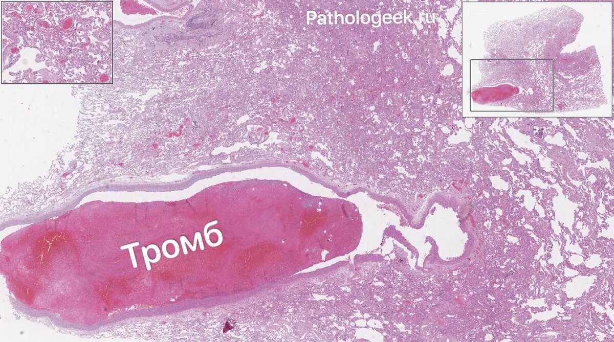 Тромб в крупном сосуде легкого