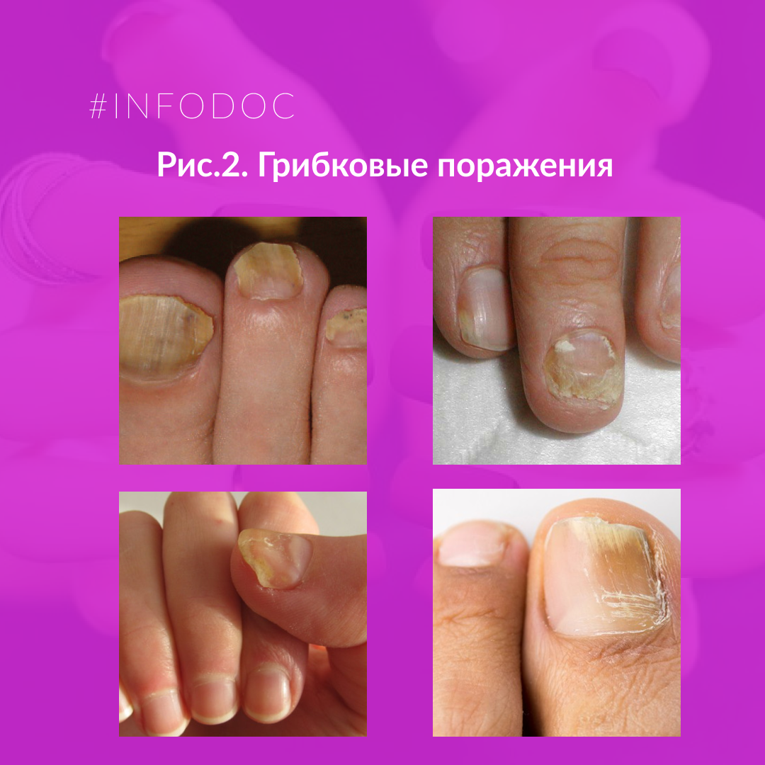 Синегнойная псевдомония на ногтях. Лечение