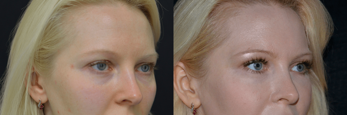 Липофилинг носослезной борозды фото до и после. Фото с сайта Д.Р. Гришкяна. Имеются противопоказания, требуется консультация специалиста