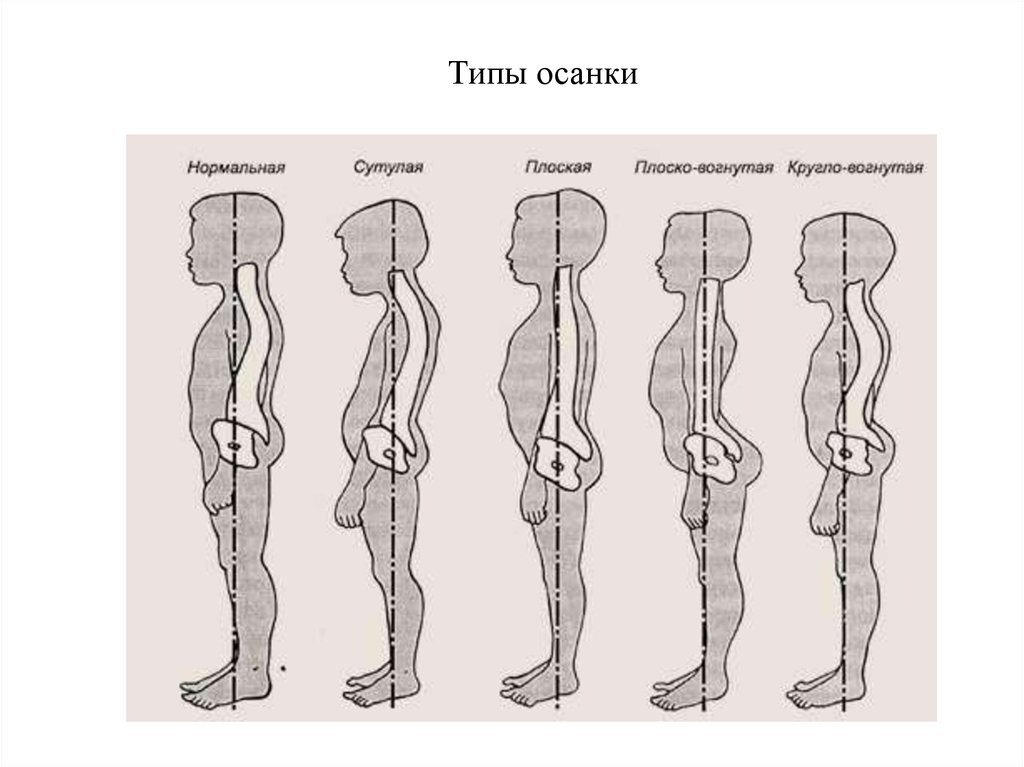 Как называется нарушение осанки изображенное на рисунке 3